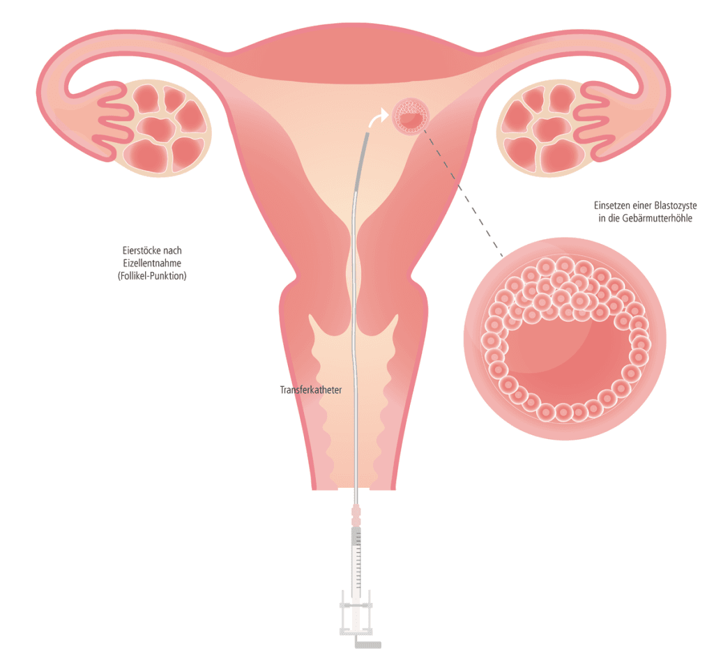 embryo transfer cyprus