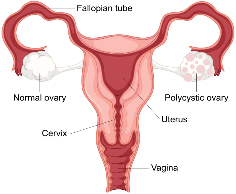 pcos