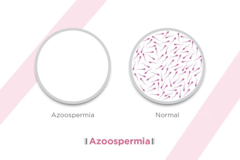 azoospermia