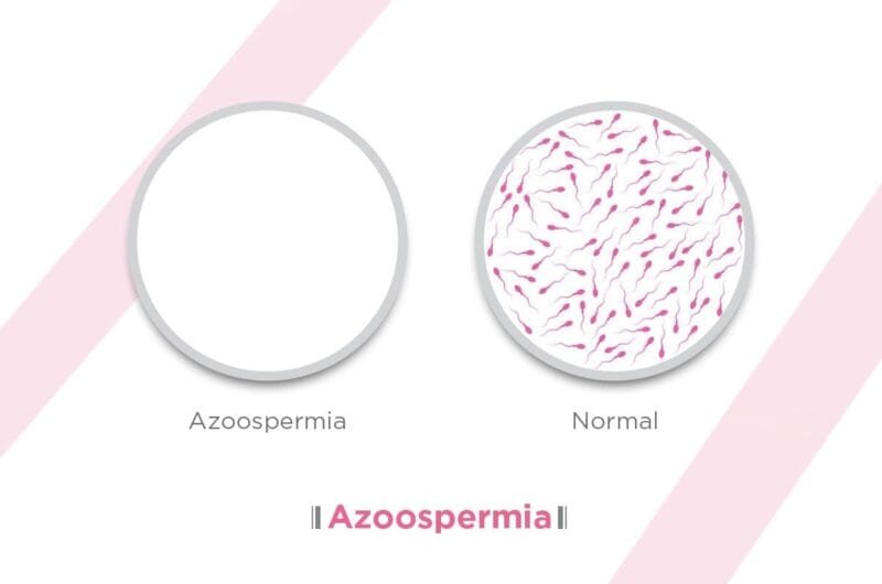 Azospermi Nedir? Belirtileri, Nedenleri & Tedavisi