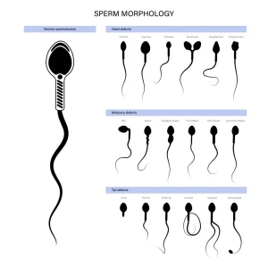 Combien de spermatozoïdes faut-il ? Valeurs normales du spermogramme