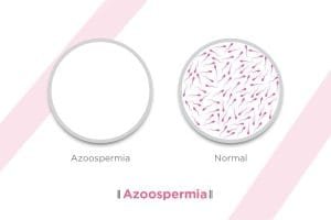Was ist Azoospermie