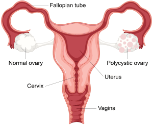 pcos